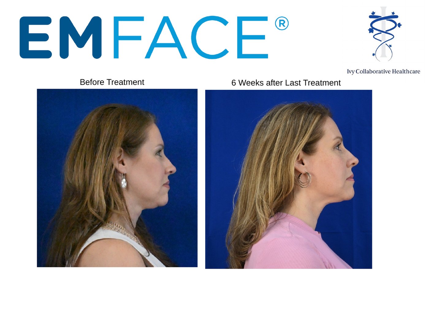 Emface before and after at Ivy Collaborative: side profile of a woman's jawline and neck before treatment and six weeks after the last treatment.