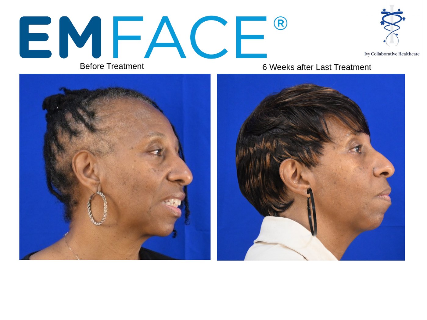 Emface before and after at Ivy Collaborative: side profile of a woman's jawline and neck before treatment and six weeks after the last treatment.