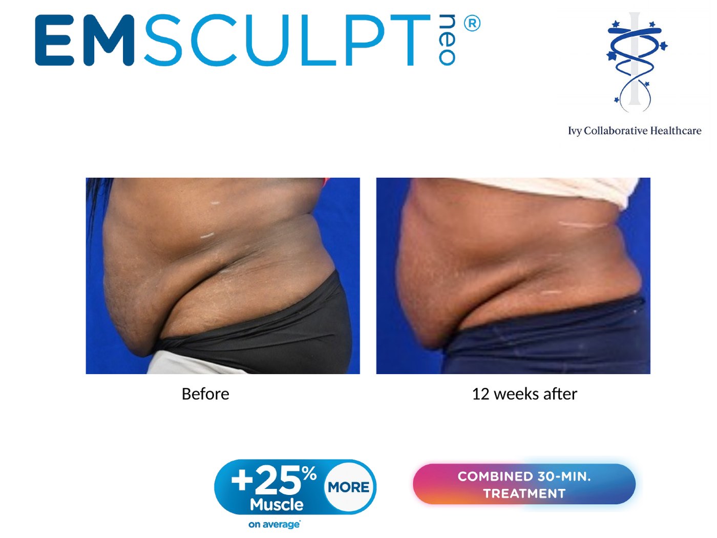 Emsculpt NEO before and after at Ivy Collaborative: side view of a patient's abdomen before treatment and twelve weeks after.
