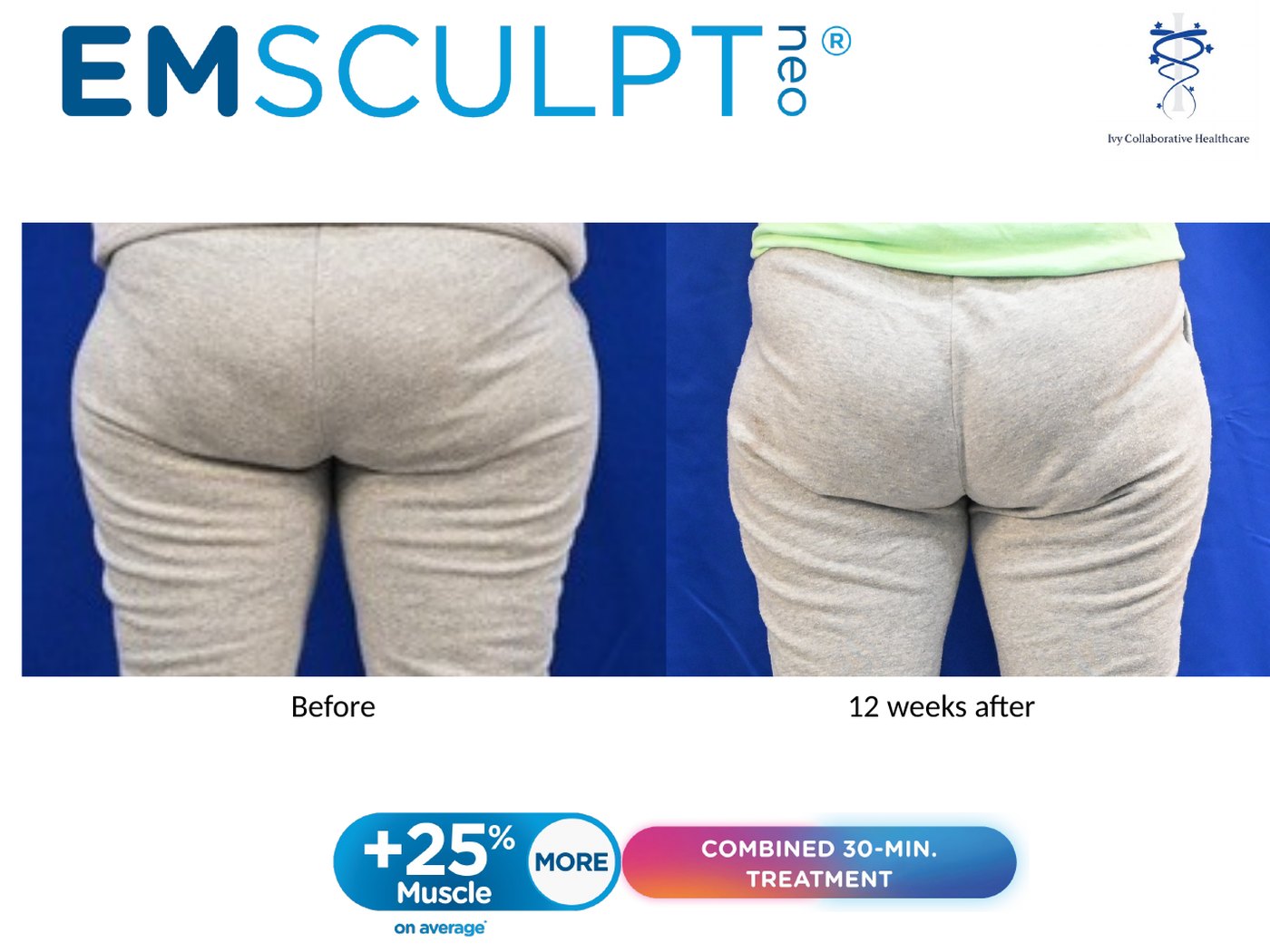 Emsculpt NEO before and after at Ivy Collaborative: rear view of a patient's buttocks and upper thighs before treatment and twelve weeks after.