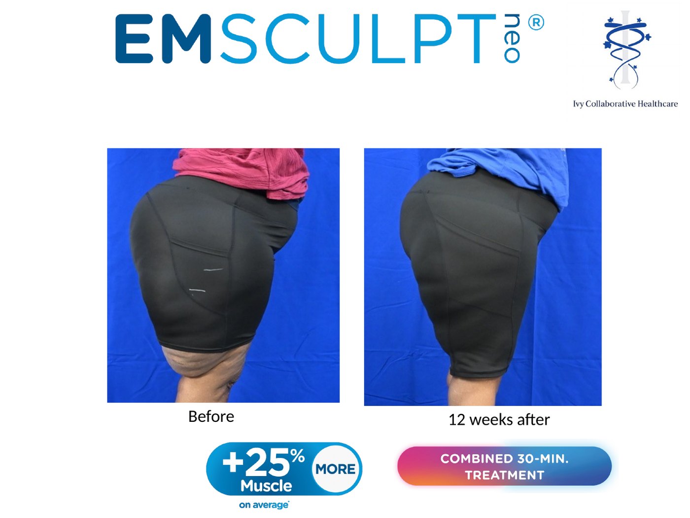 Emsculpt NEO before and after at Ivy Collaborative: angled view of a patient's hip and thigh before treatment and twelve weeks after.