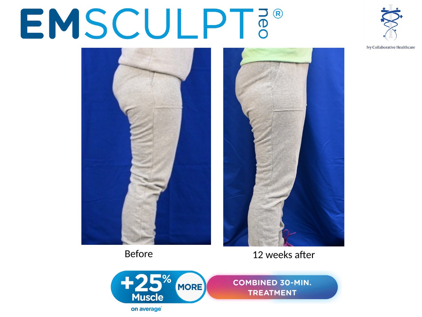 Emsculpt NEO before and after at Ivy Collaborative: side view of a patient's hip and thigh before treatment and twelve weeks after.