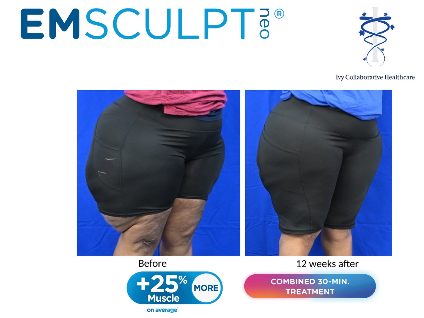 Emsculpt NEO before and after at Ivy Collaborative: rear angled view of a patient's thighs and buttocks before treatment and twelve weeks after.