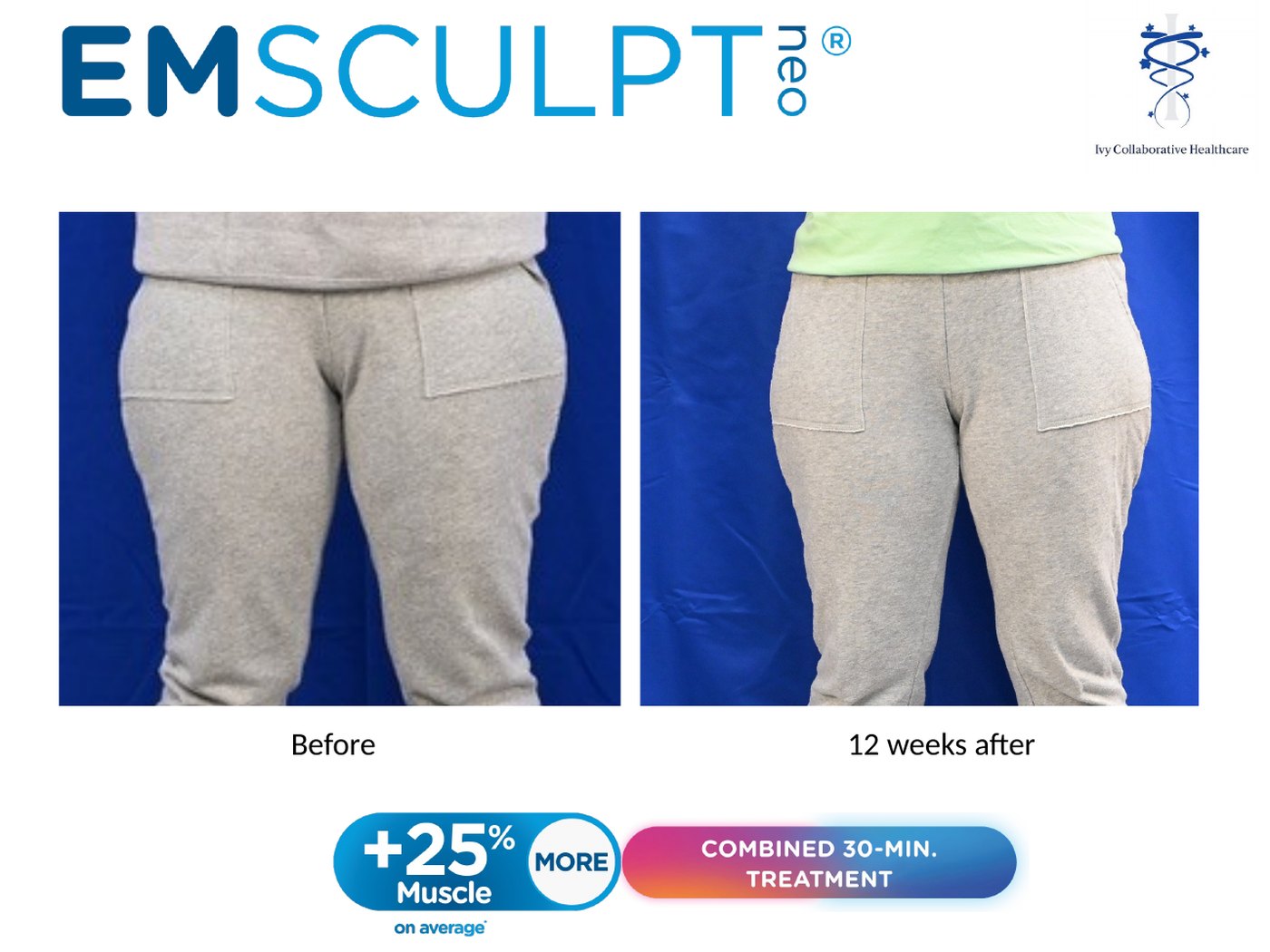 Emsculpt NEO before and after at Ivy Collaborative: front view of a patient's thighs before treatment and twelve weeks after.